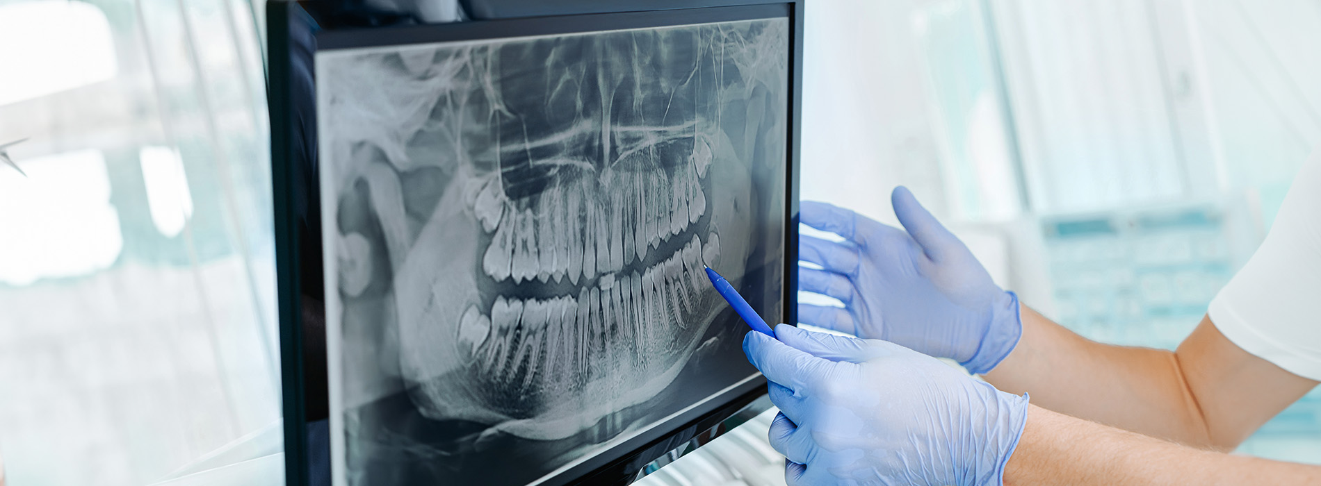 A dental professional wearing gloves inspects an X-ray image on a computer screen.