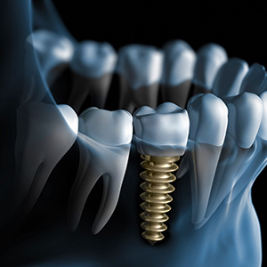 Alt  A detailed 3D rendering showing a dental implant screwed into a tooth socket with surrounding teeth and gums, emphasizing the precision of dental implantation procedures.