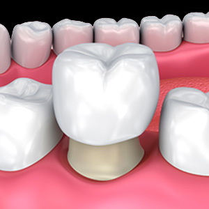 The image shows a close-up view of a set of human teeth with an emphasis on a dental implant in the foreground, displaying the artificial tooth structure and its integration into the natural teeth.