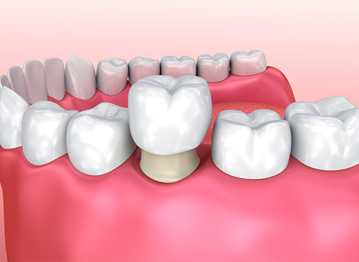 Cosmetic Dental Veneers