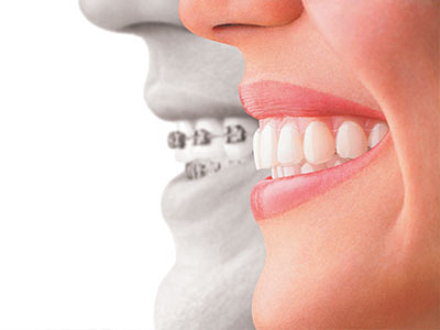 The image shows a composite of a person s face with an overlay of a dental implant on the right side, positioned between two natural teeth.