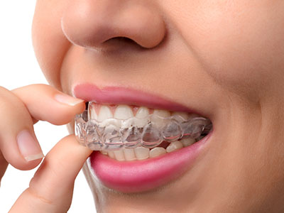 The image shows a person with a clear aligner on their teeth, holding up a finger to their mouth, possibly demonstrating the use of the aligners for dental correction.