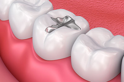 The image features a close-up view of a dental implant embedded in a tooth within an oral cavity, with surrounding teeth and gums visible.