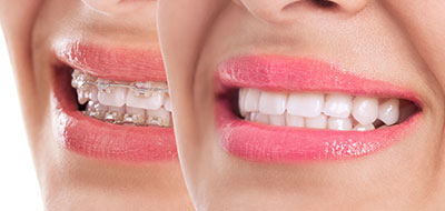 The image shows a close-up of a person s face with a focus on their teeth and lips.