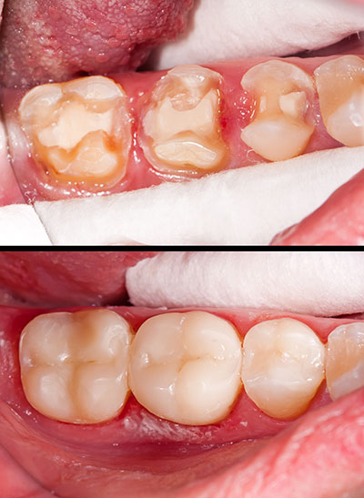 The image shows a person s mouth with teeth undergoing dental treatment, likely showing before and after stages of a cosmetic dental procedure.