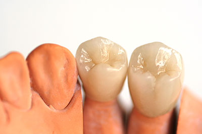 The image shows two sets of artificial teeth, one with an upper and lower pair and the other with just a single tooth, placed side by side against a white background.