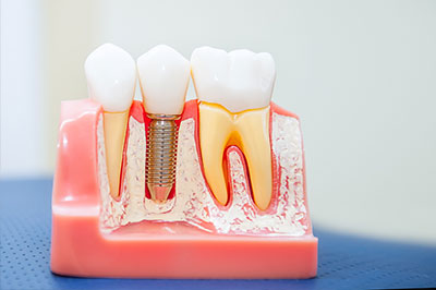 The image shows a model of human teeth with dental implants, displaying various stages of tooth replacement and implant placement, set against a pink background.