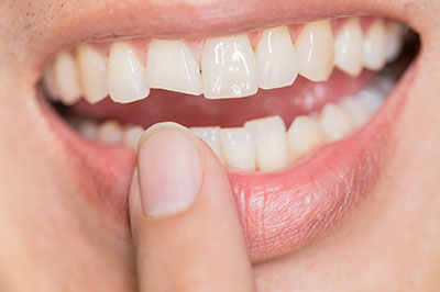 The image shows a close-up of a person s mouth with teeth, holding their finger near the teeth while smiling.