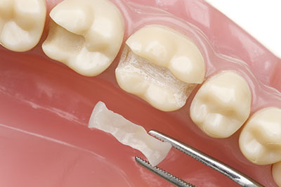 An image showcasing a dental implant process with a tooth being prepared for placement.
