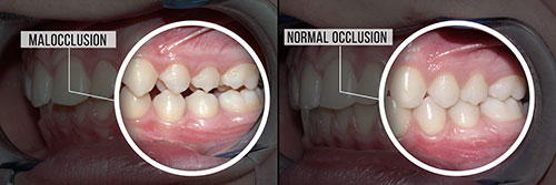 The image shows two photographs side by side of a person s mouth with teeth before and after dental treatment, highlighting the transformation from normal occlusion to malocclusion.