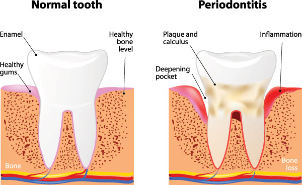The image depicts a detailed illustration showing different stages of tooth decay progression from normal to gum disease, with annotations explaining each stage.