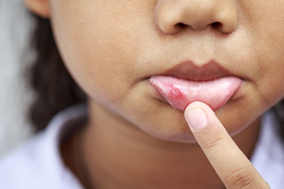 A young child with a finger on their lips, showing a close-up of their skin with visible redness or irritation around the mouth area.