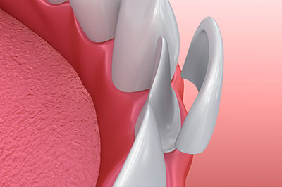 The image shows a detailed view of an artificial tooth implant with a pink gum background.