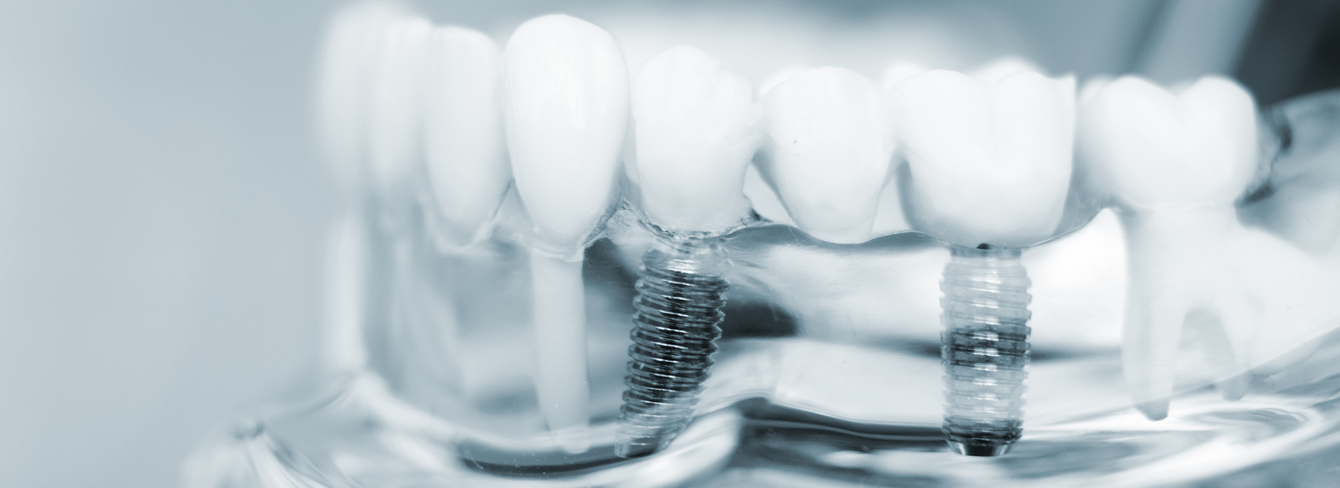 The image shows a close-up view of a dental implant with screws and screw heads, set against a blurred background that suggests a clinical setting.