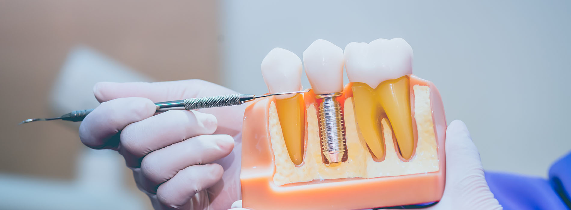 The image shows a person holding an orange object with a small screw on it near a dental drill, suggesting preparation for dental work.