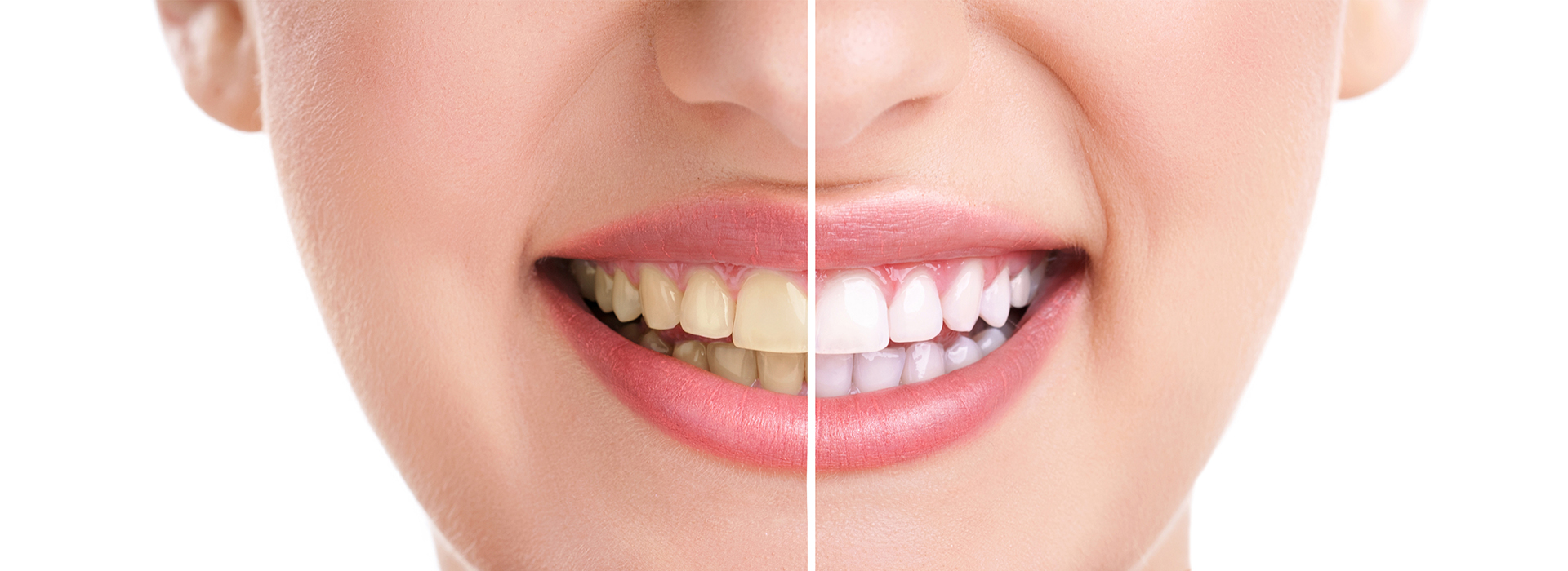 The image displays a close-up view of a person s face with a focus on their teeth, emphasizing dental care and oral health improvement.