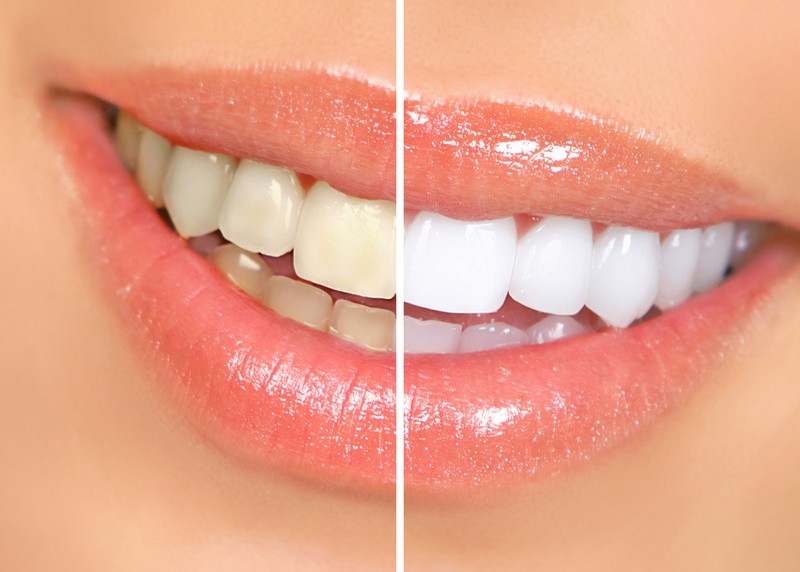 Don’t Whiten Your Teeth at Home Without Reading This