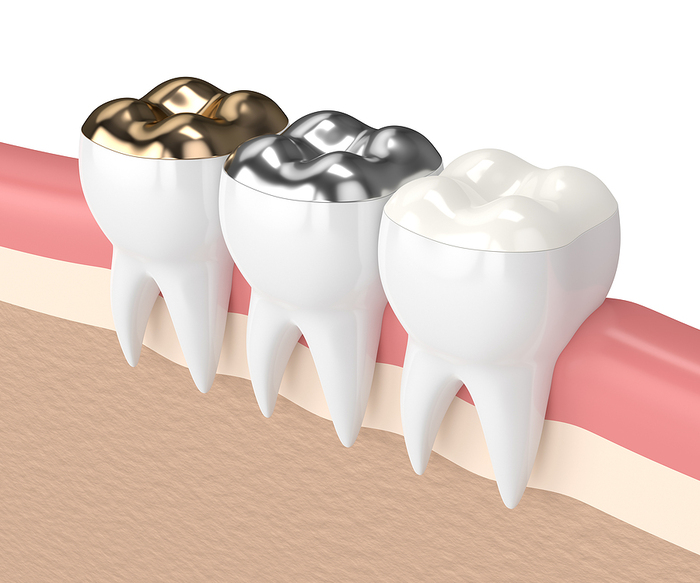 What Are The Latest Materials Used For Cavities