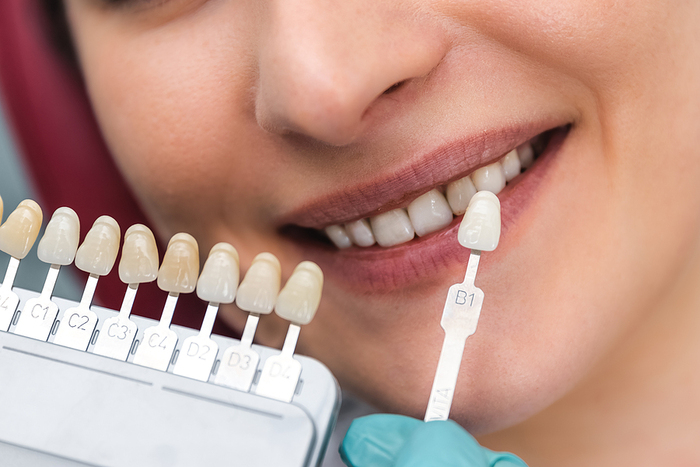 How Do You Know If Veneers Are Right For You
