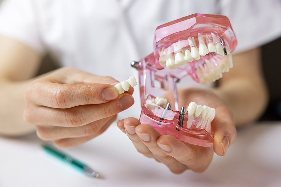 Dental Sealants and Dental Veneers Explained