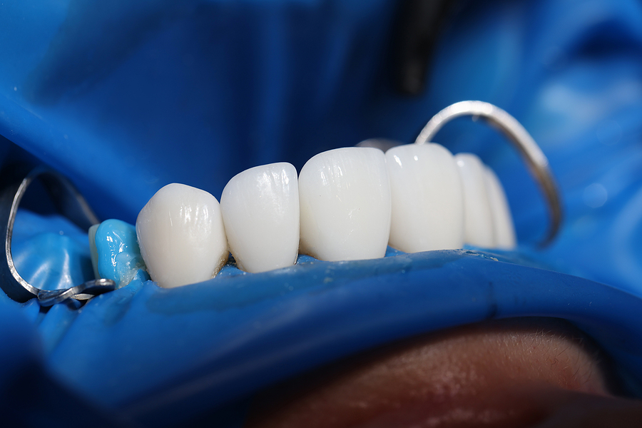 Dental Veneers and Implants.